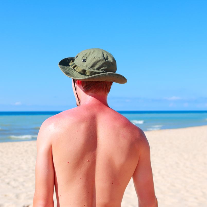 Man With A Burnt Bare Back On The Beach