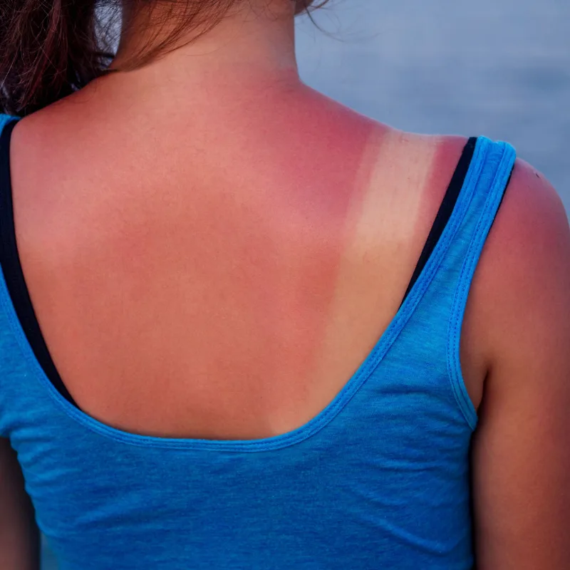 Woman with a burnt back on a beach